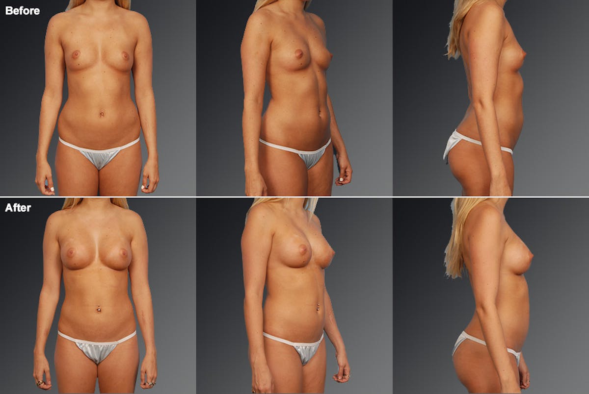 Liposuction Before & After Gallery - Patient 106009058 - Image 1