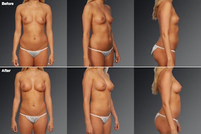 Liposuction Before & After Gallery - Patient 106009058 - Image 1