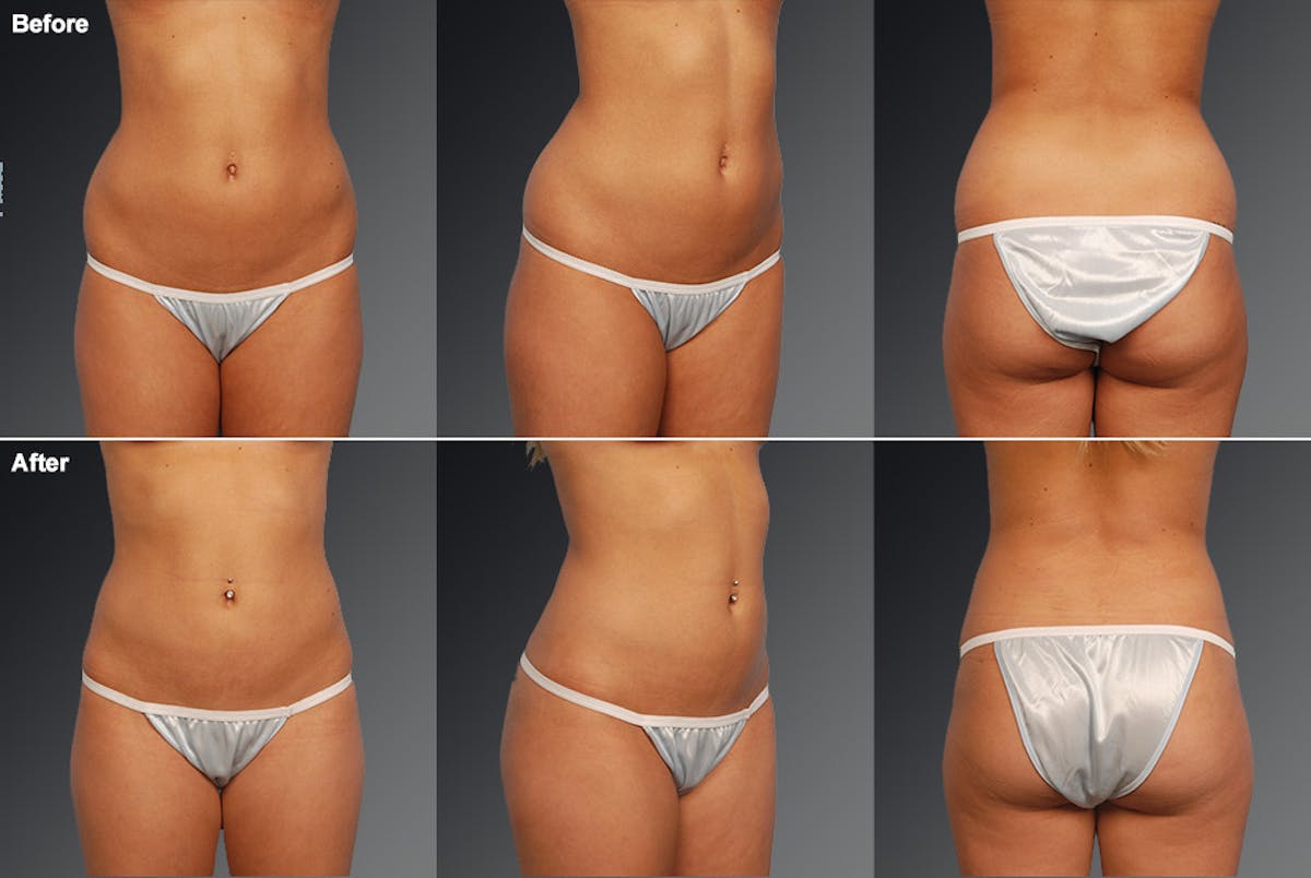 Liposuction Before & After Gallery - Patient 106009059 - Image 1