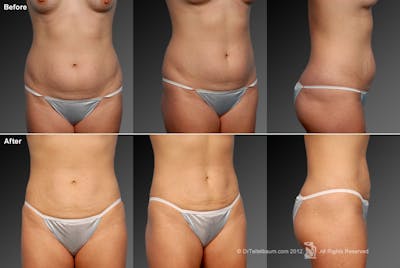 Liposuction Before & After Gallery - Patient 106009061 - Image 1