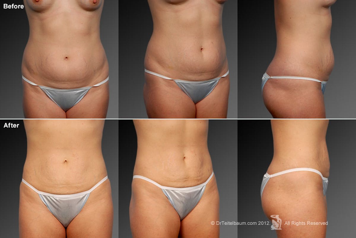 Liposuction Before & After Gallery - Patient 106009061 - Image 1