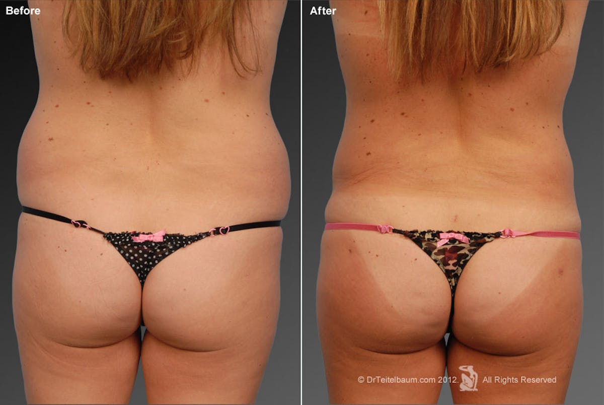 Liposuction Before & After Gallery - Patient 106009062 - Image 1