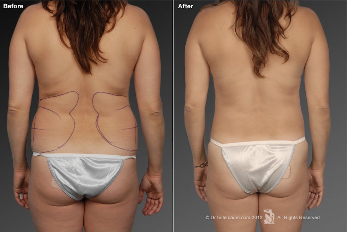 Liposuction Before & After Gallery - Patient 106009063 - Image 1