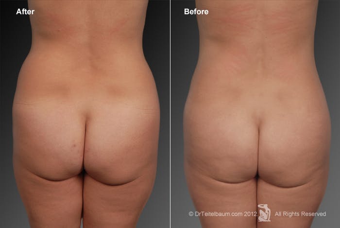 Liposuction Before & After Gallery - Patient 106009064 - Image 1