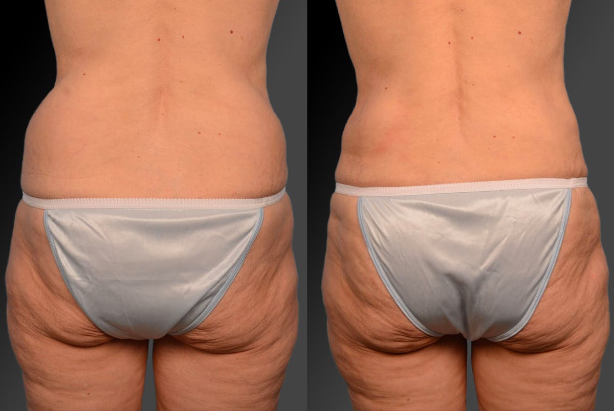 Liposuction Before & After Gallery - Patient 106009065 - Image 1