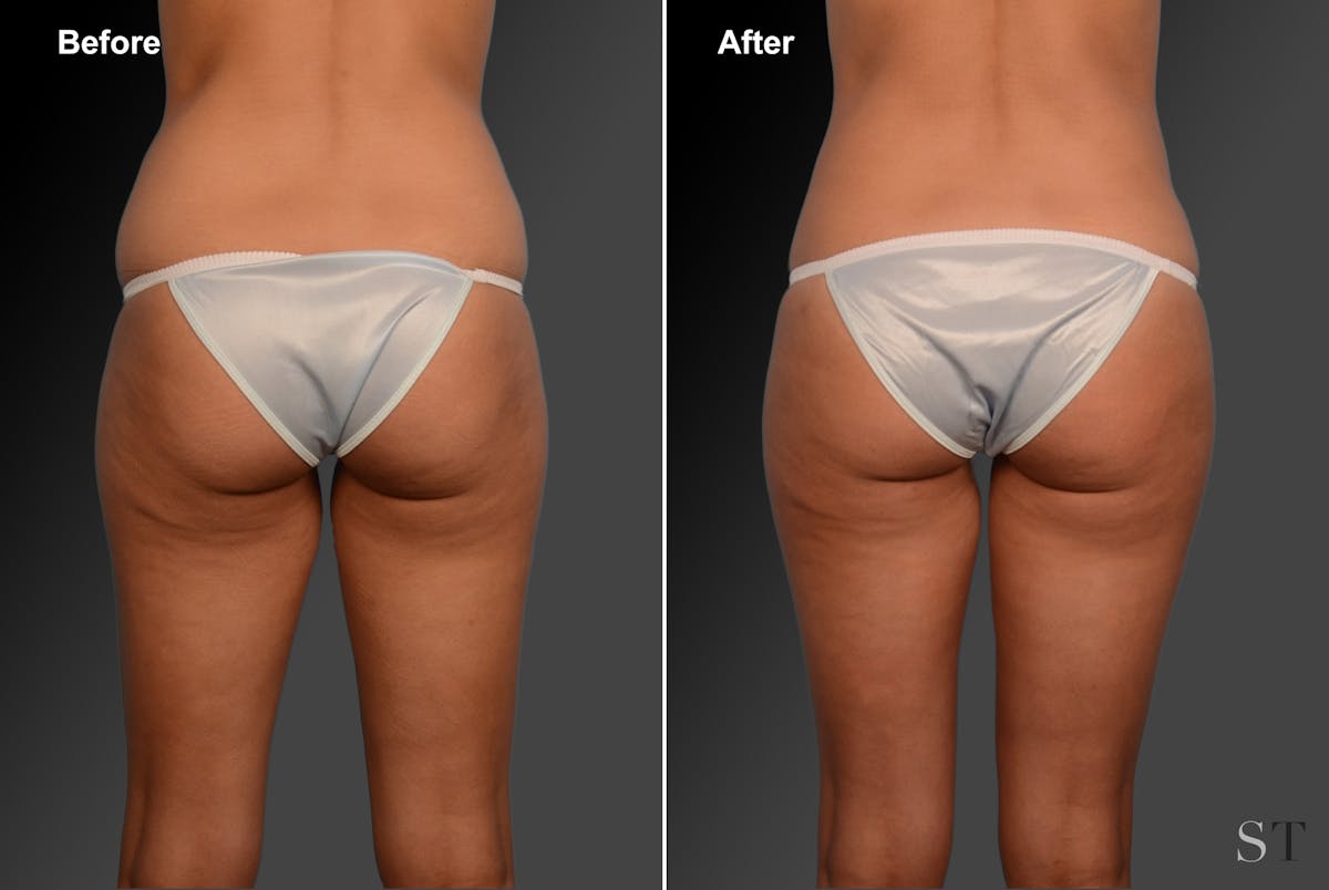 Liposuction Before & After Gallery - Patient 106009066 - Image 1