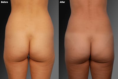 Liposuction Before & After Gallery - Patient 106009067 - Image 1