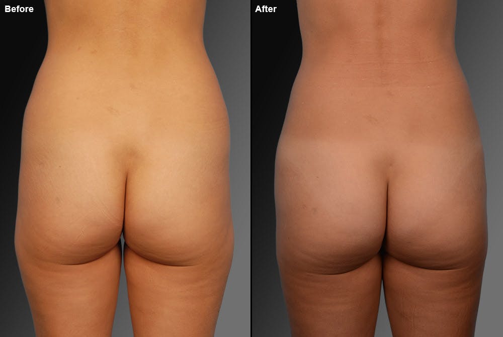 Liposuction Before & After Gallery - Patient 106009067 - Image 1