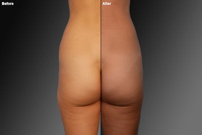 Liposuction Before & After Gallery - Patient 106009068 - Image 1