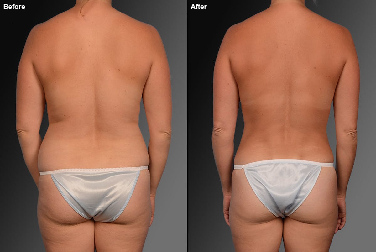 Liposuction Before & After Gallery - Patient 106009069 - Image 1