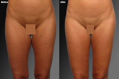 Liposuction Before & After Gallery - Patient 106009070 - Image 1