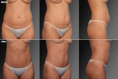 Liposuction Before & After Gallery - Patient 106009071 - Image 1