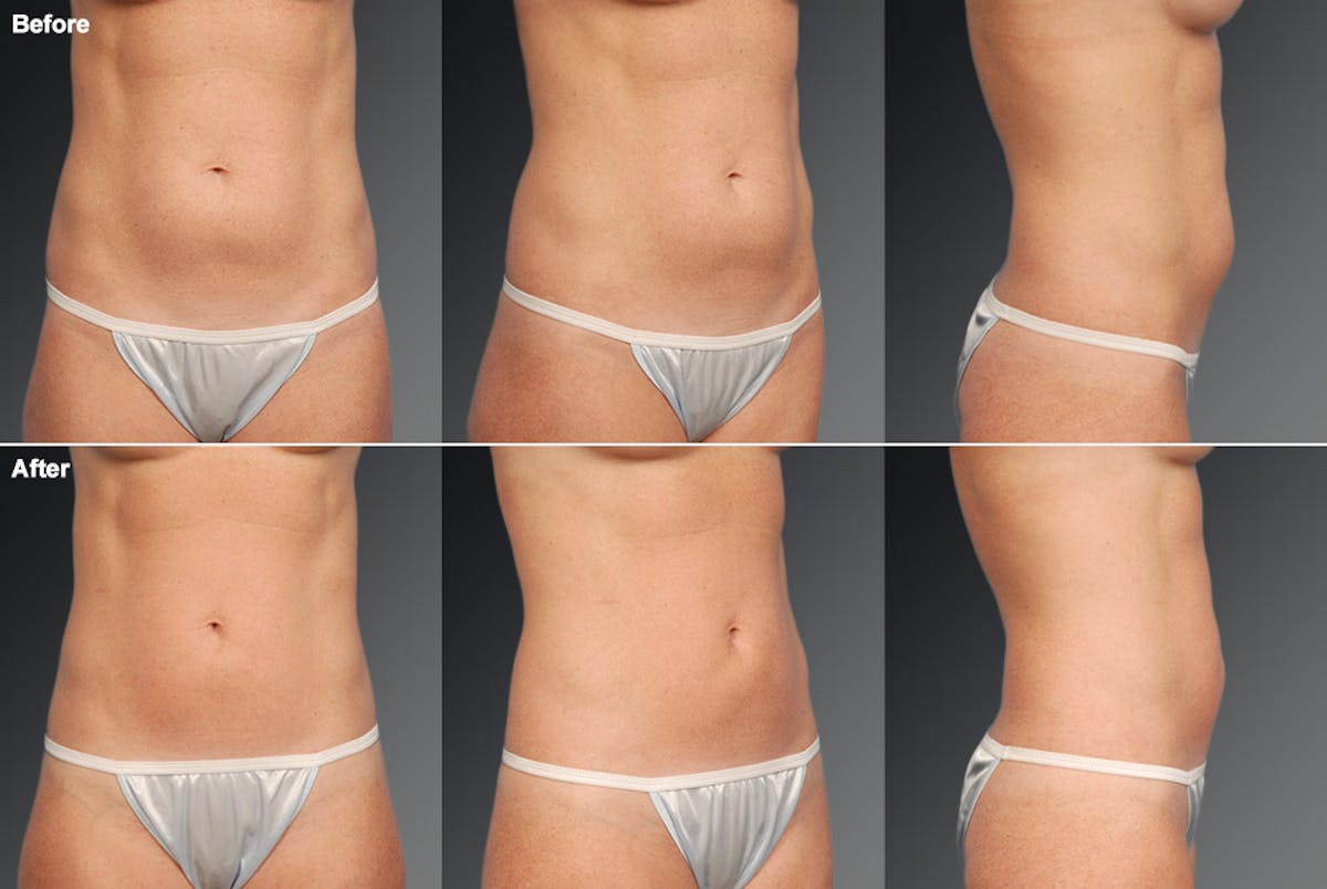 Liposuction Before & After Gallery - Patient 106009072 - Image 1