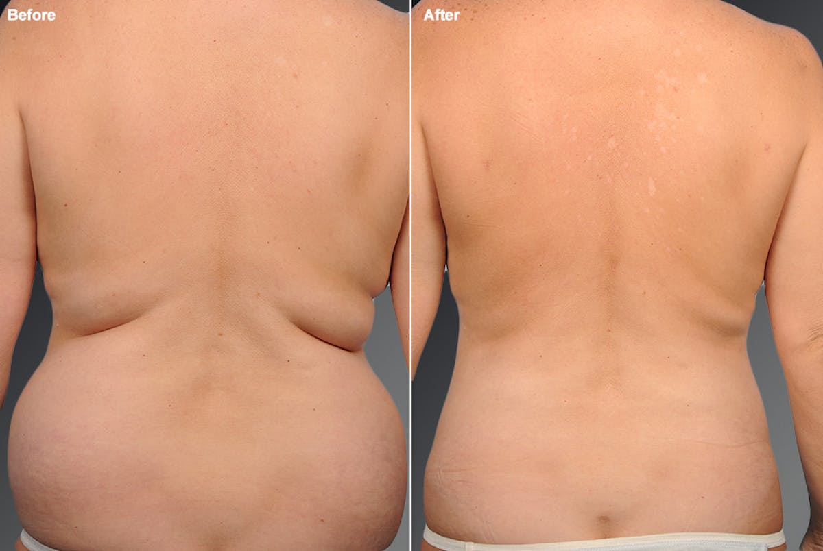 Liposuction Before & After Gallery - Patient 106009076 - Image 1