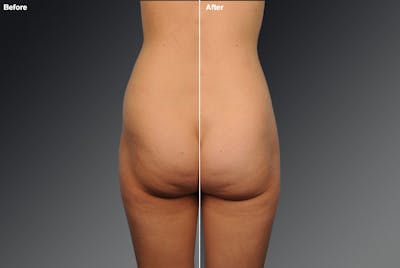 Liposuction Before & After Gallery - Patient 106009078 - Image 1
