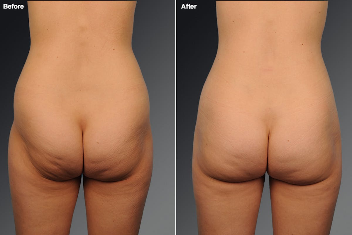 Liposuction Before & After Gallery - Patient 106009080 - Image 1