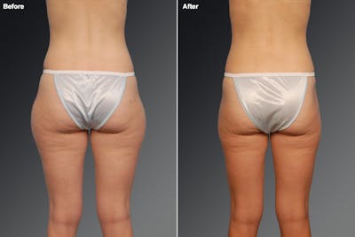 Liposuction Before & After Gallery - Patient 106009081 - Image 1