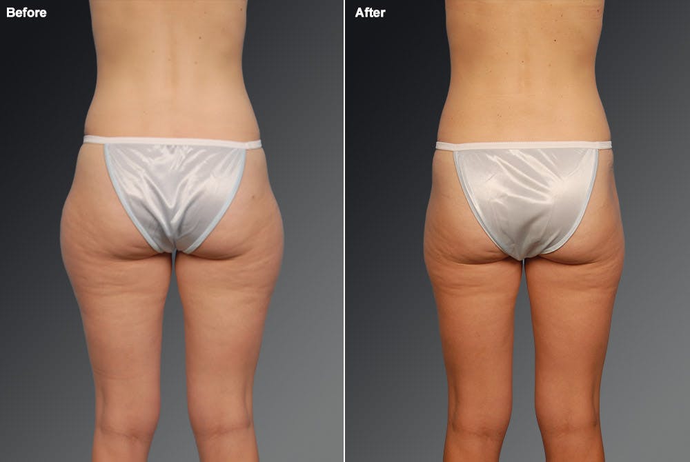 Liposuction Before & After Gallery - Patient 106009081 - Image 1