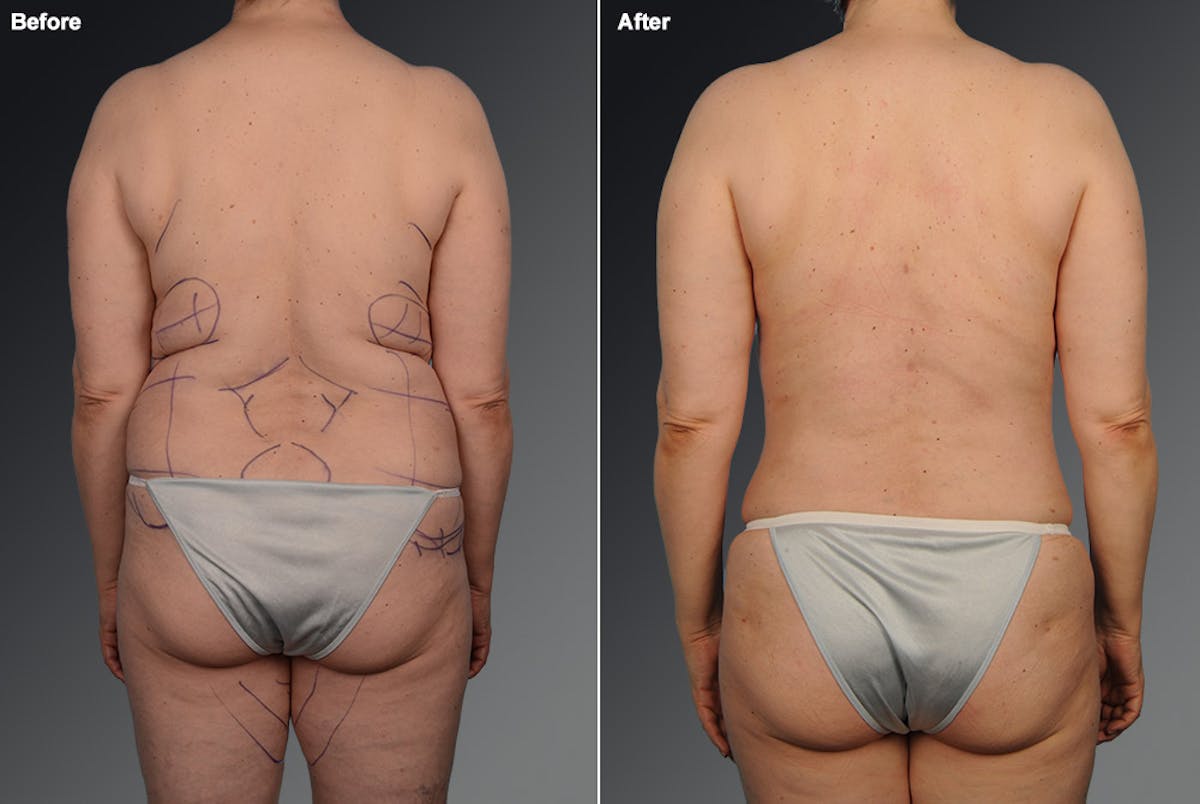 Liposuction Before & After Gallery - Patient 106009082 - Image 1