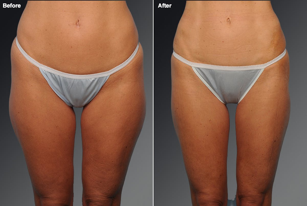 Liposuction Before & After Gallery - Patient 106009083 - Image 1