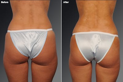 Liposuction Before & After Gallery - Patient 106009084 - Image 1