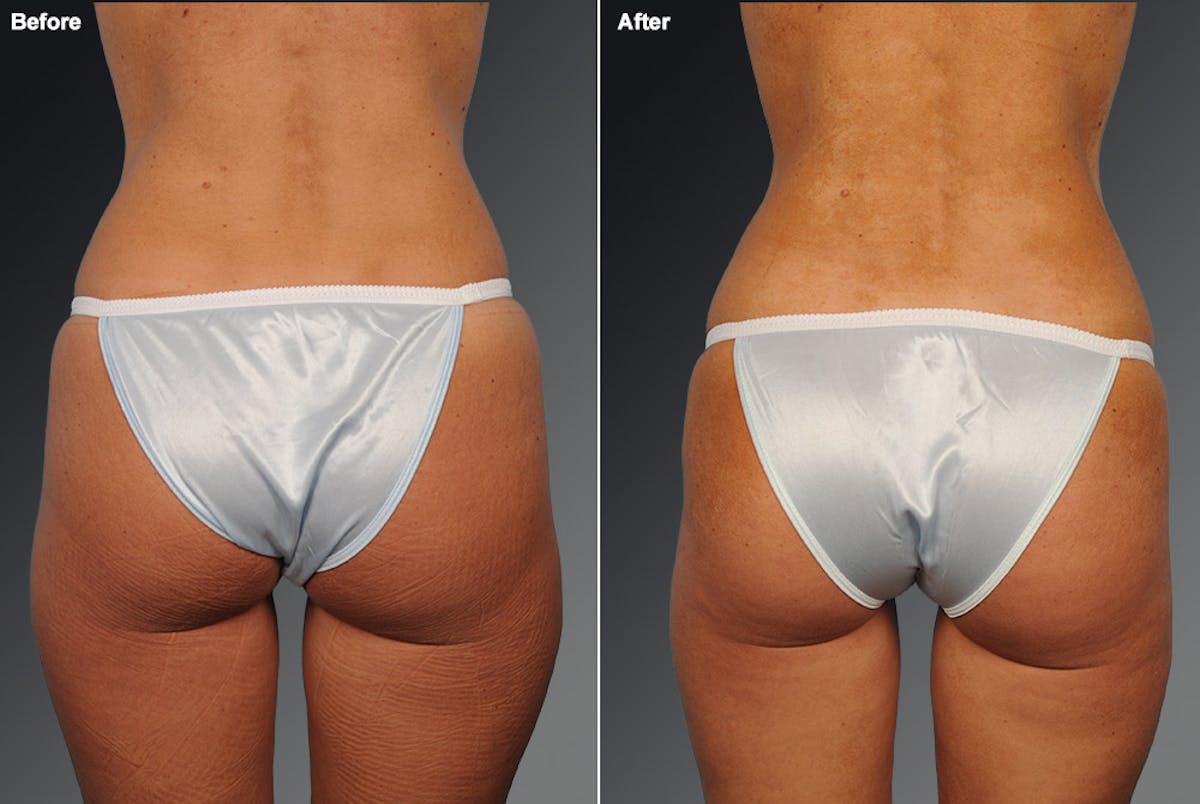 Liposuction Before & After Gallery - Patient 106009084 - Image 1