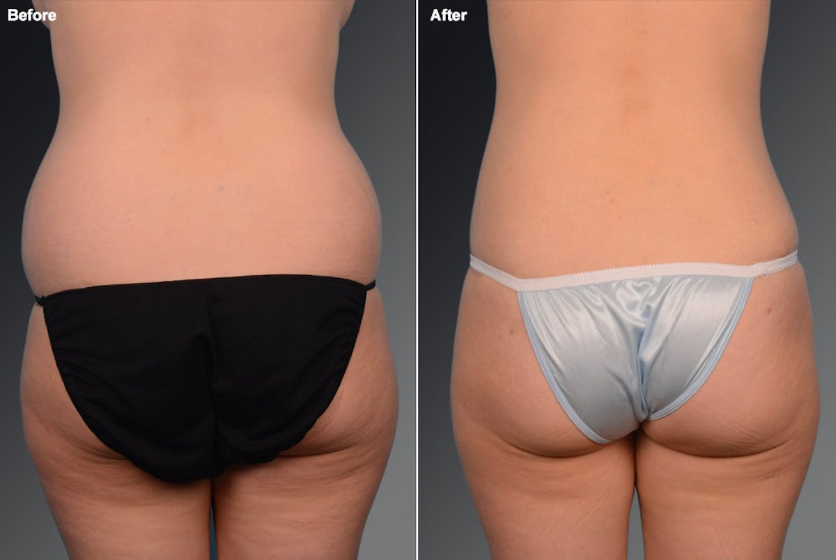 Liposuction Before & After Gallery - Patient 106009086 - Image 1
