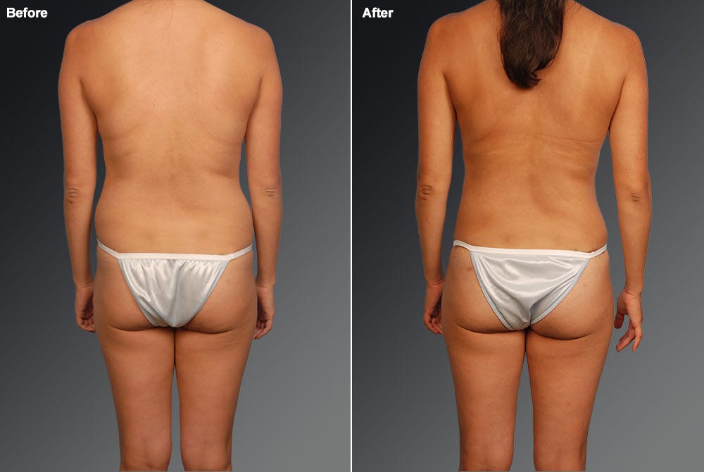 Liposuction Before & After Gallery - Patient 106009087 - Image 1