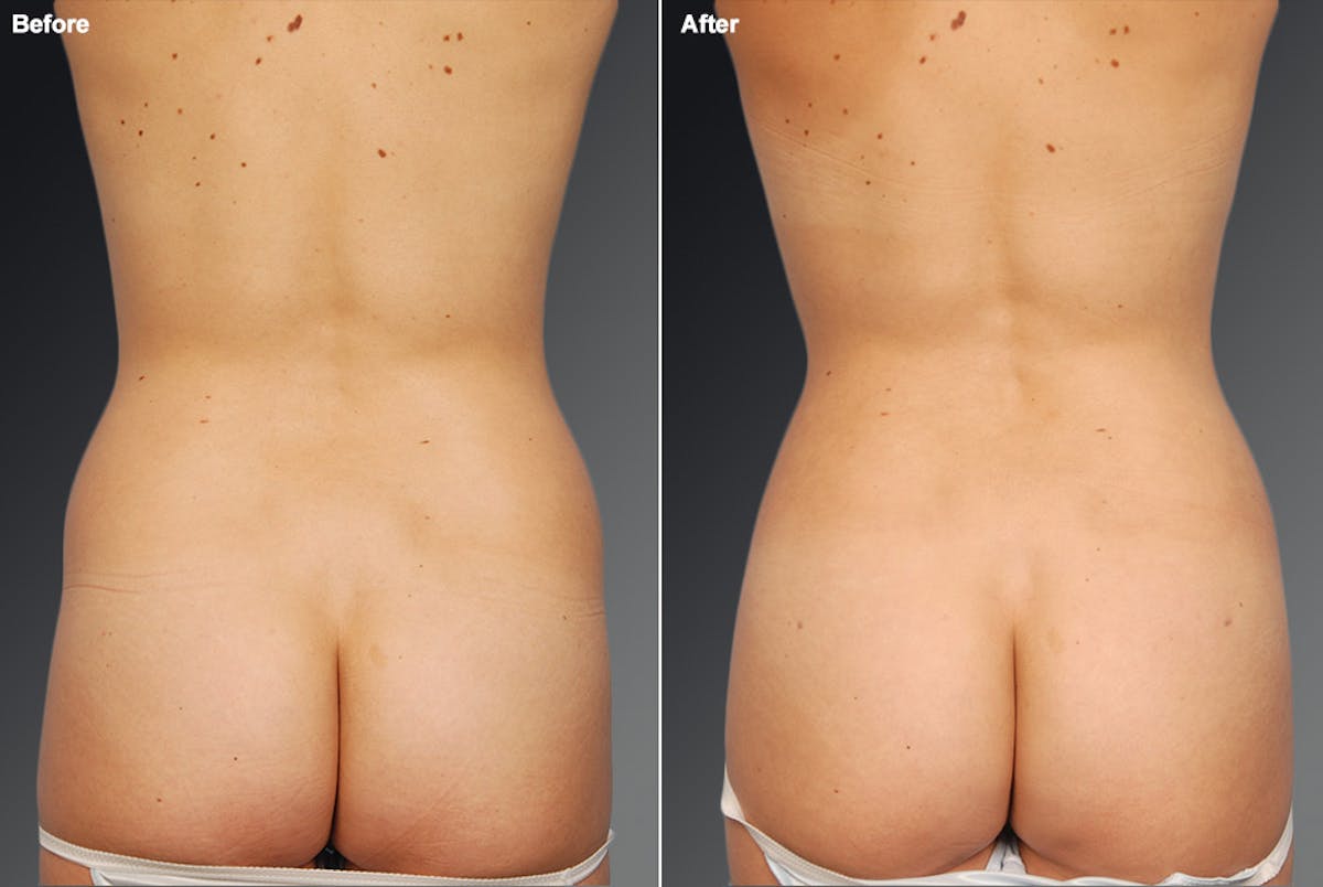 Liposuction Before & After Gallery - Patient 106009088 - Image 1