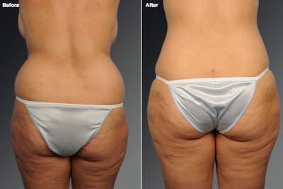 Liposuction Before & After Gallery - Patient 106009089 - Image 1