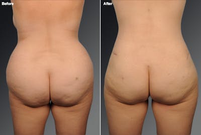 Liposuction Before & After Gallery - Patient 106009091 - Image 1