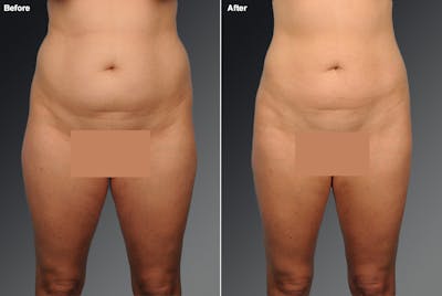 Liposuction Before & After Gallery - Patient 106009092 - Image 1