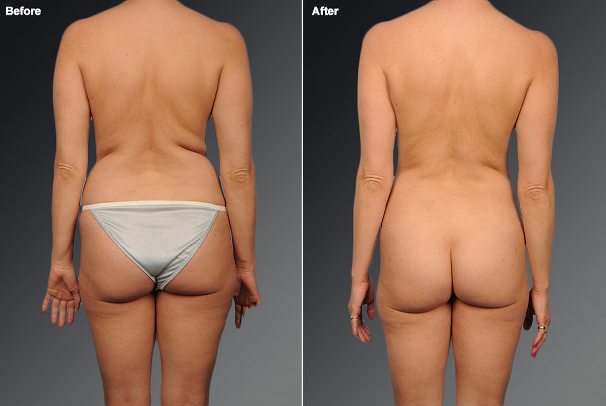 Liposuction Before & After Gallery - Patient 106009093 - Image 1