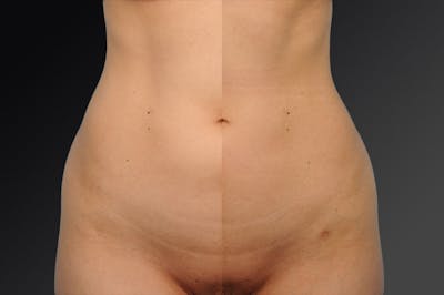 Liposuction Before & After Gallery - Patient 106009094 - Image 1