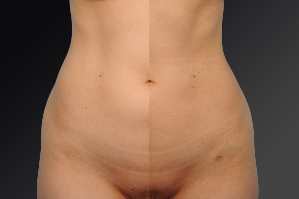 Liposuction Before & After Gallery - Patient 106009094 - Image 1