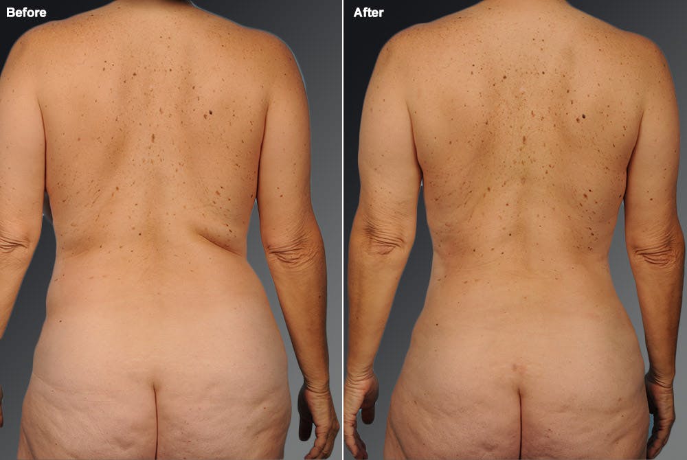 Liposuction Before & After Gallery - Patient 106009095 - Image 1