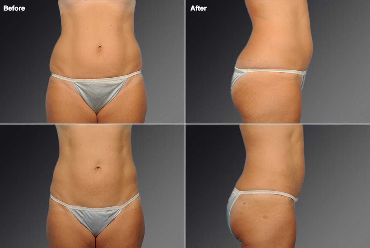 Liposuction Before & After Gallery - Patient 106009096 - Image 1