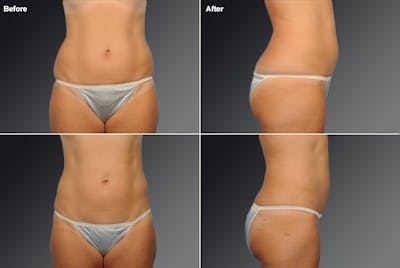 Liposuction Before & After Gallery - Patient 106009096 - Image 1