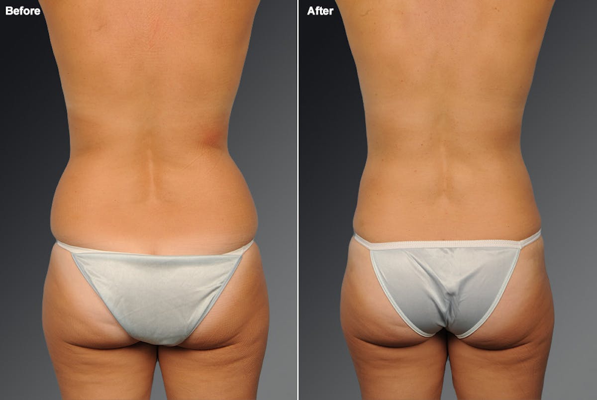 Liposuction Before & After Gallery - Patient 106009097 - Image 1