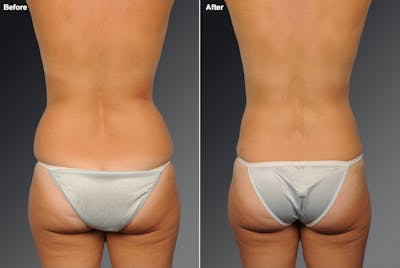 Liposuction Before & After Gallery - Patient 106009097 - Image 1