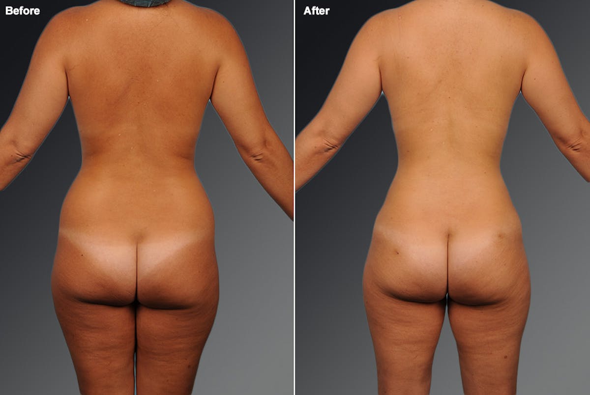 Liposuction Before & After Gallery - Patient 106009098 - Image 1