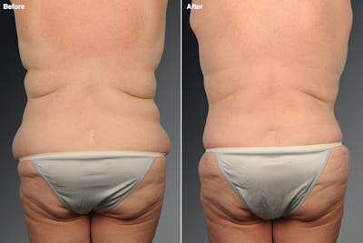 Liposuction Before & After Gallery - Patient 106009099 - Image 1