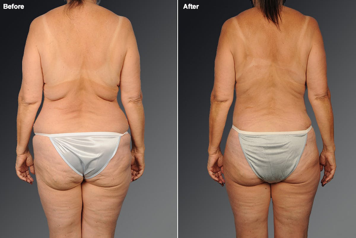 Liposuction Before & After Gallery - Patient 106009100 - Image 1