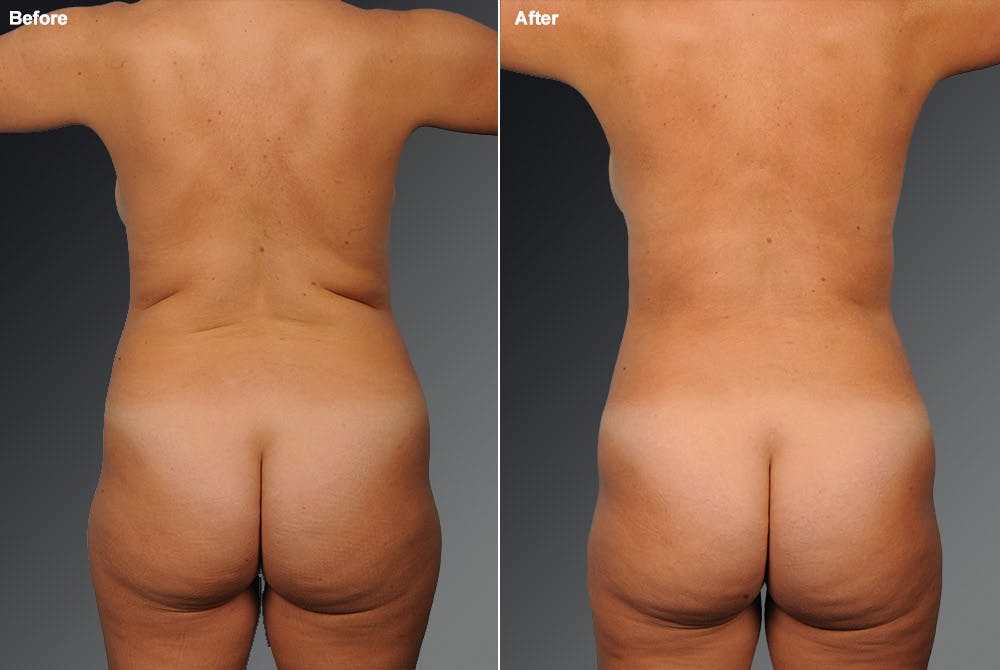 Liposuction Before & After Gallery - Patient 106009101 - Image 1