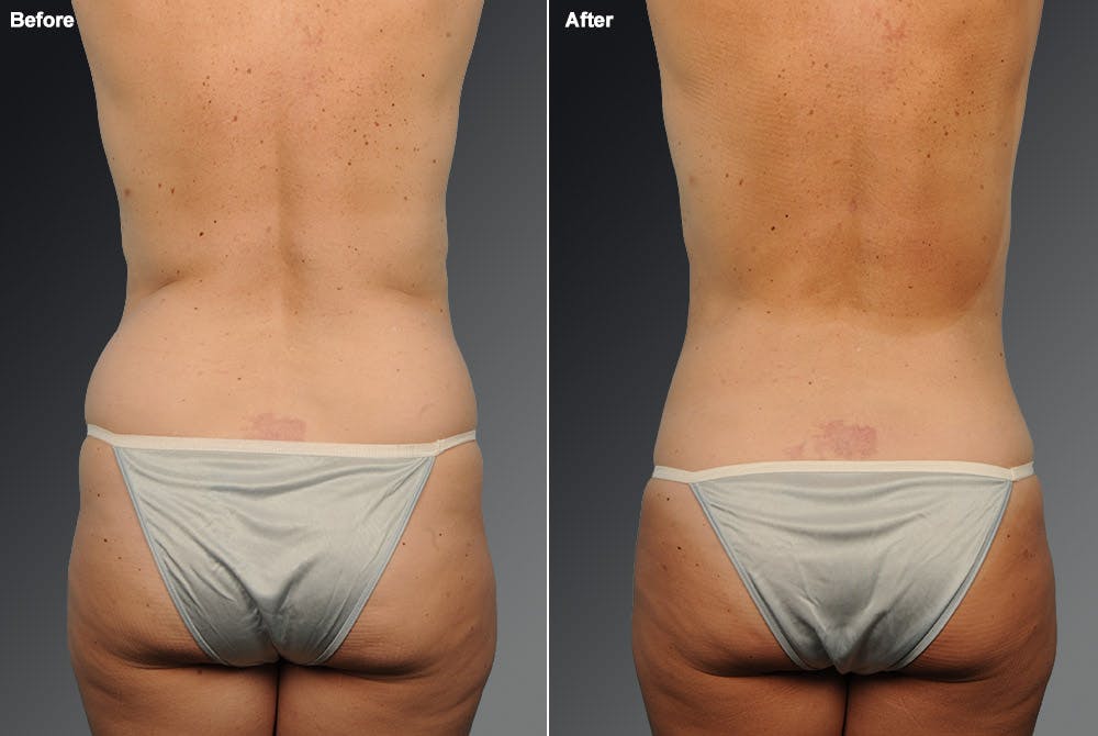 Liposuction Before & After Gallery - Patient 106009103 - Image 1