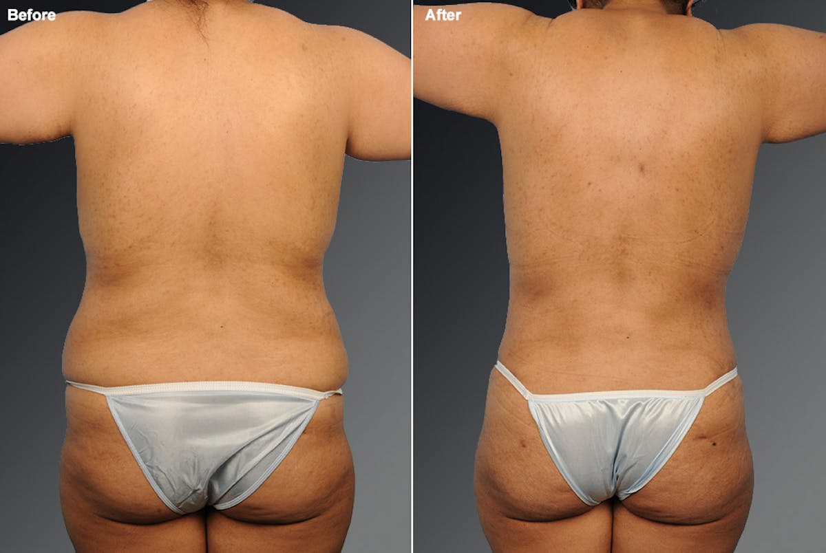 Liposuction Before & After Gallery - Patient 106009104 - Image 1