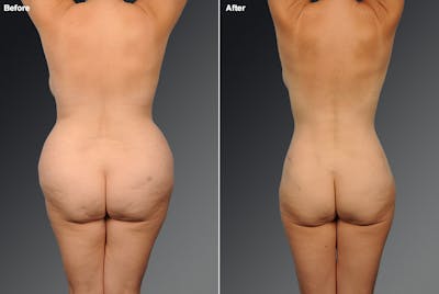 Liposuction Before & After Gallery - Patient 106009105 - Image 1