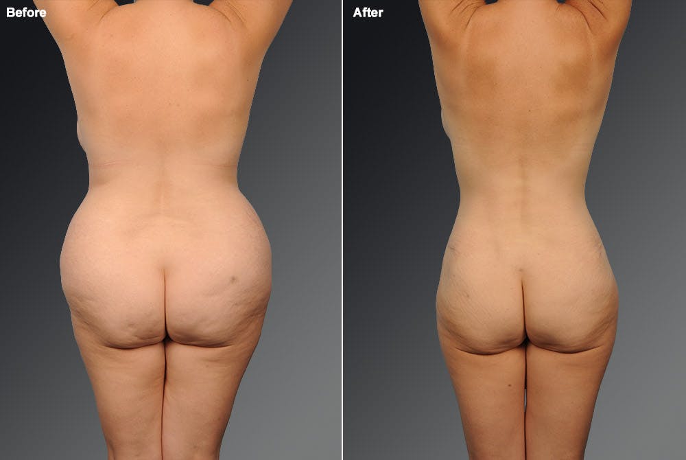 Liposuction Before & After Gallery - Patient 106009105 - Image 1