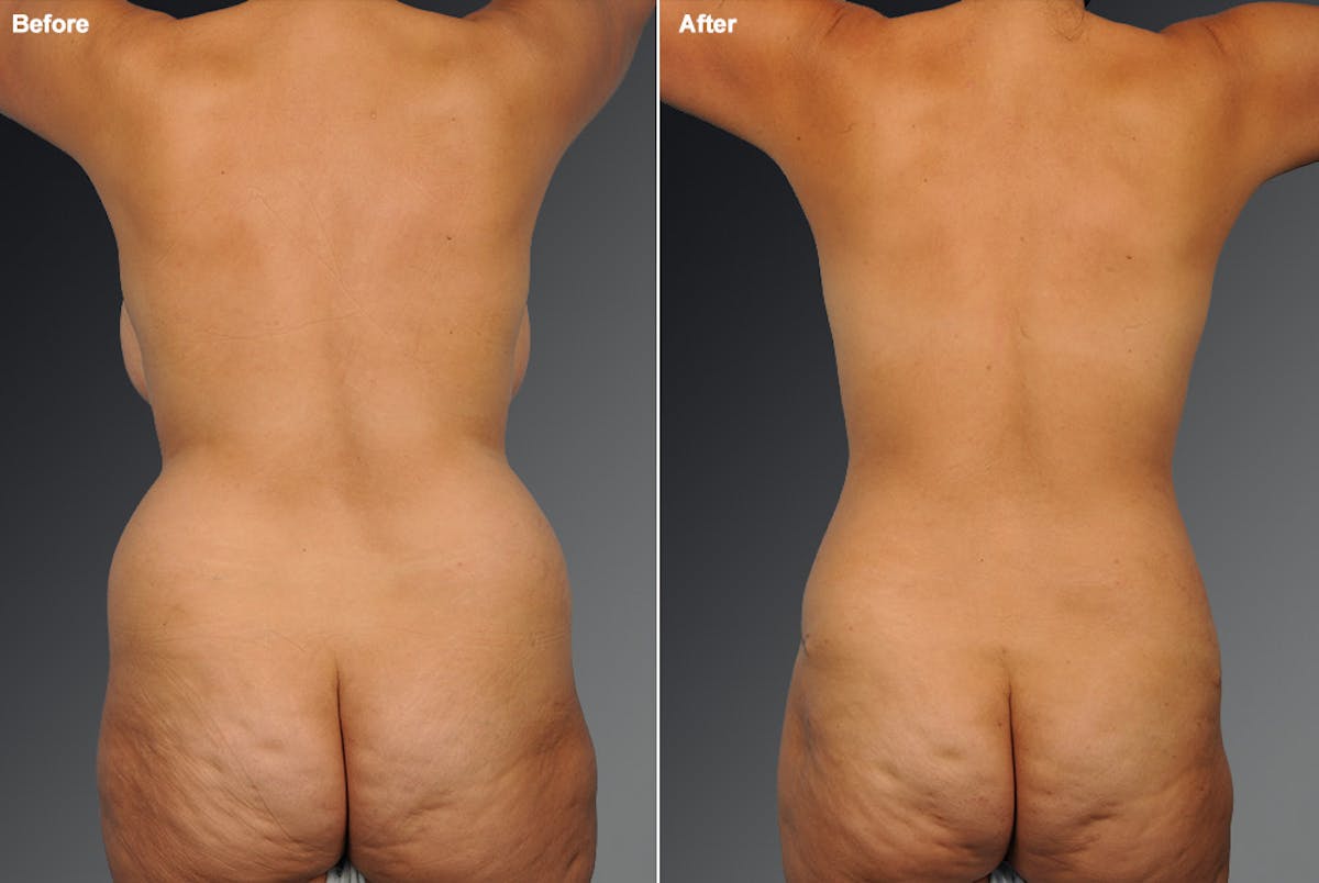 Liposuction Before & After Gallery - Patient 106009106 - Image 1