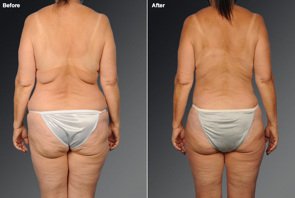 Liposuction Before & After Gallery - Patient 106009107 - Image 1